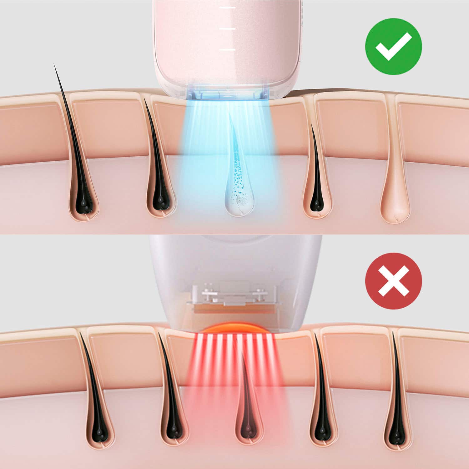 Ulike - Dispositivo de remoção de pêlos IPL com resfriamento de gelo Air 3 - Rosa-UI06 PN